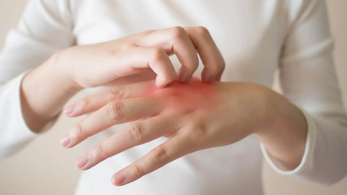 ¿Qué es la dermatitis atópica y cuáles son sus causas y síntomas?