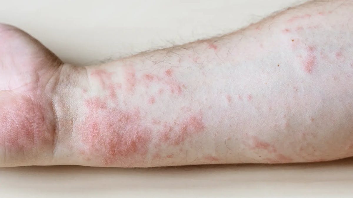 ¿Qué es la dermatitis de contacto y cuáles son sus síntomas?