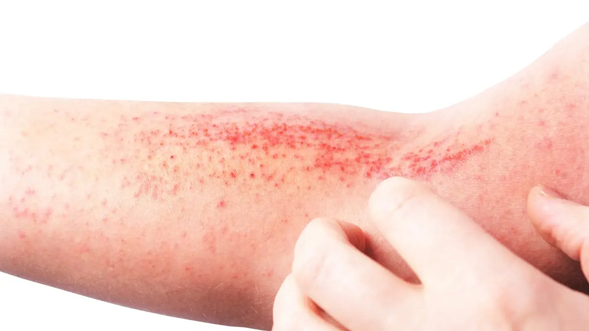 ¿Qué es y cuál es la causa de la dermatitis herpetiforme?