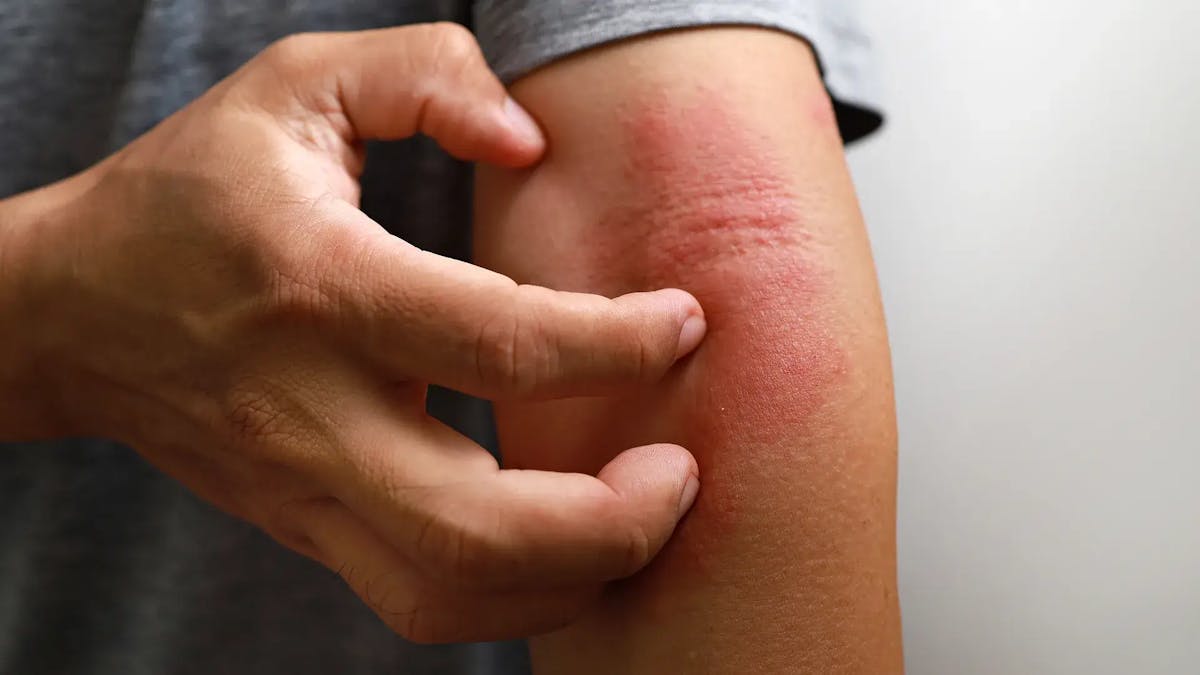 ¿Qué es el Eczema y cómo detectarlo?